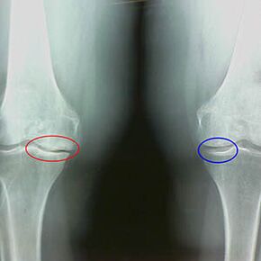 Arthrose de l'articulation du genou sur l'image x-ray