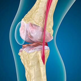 Une tension excessive du muscle de la cuisse provoque la douleur dans le genou