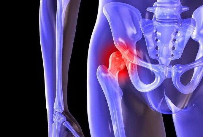 Processus pathologique dans l'articulation de la hanche avec coxarthrose